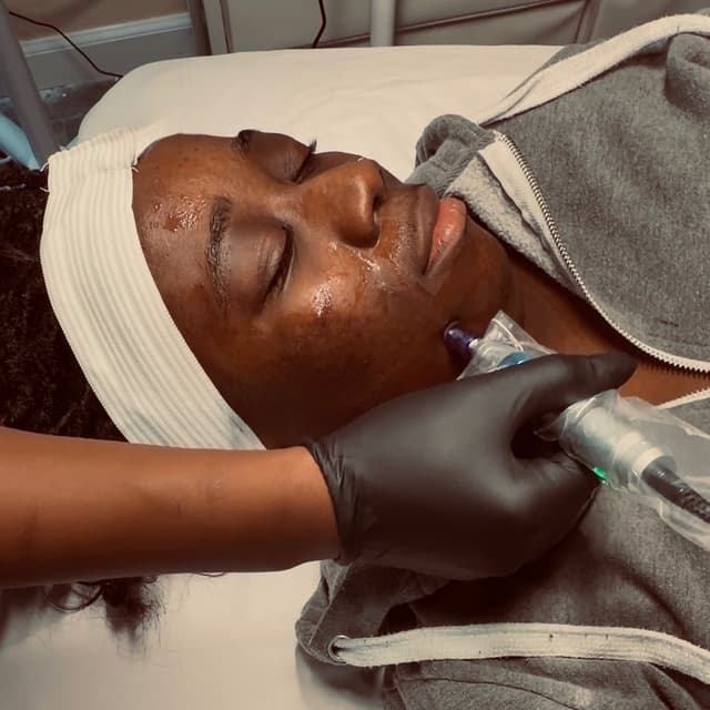 Microneedling - 3 months at Refinery Aesthetics Loft in Oxon Hill, MD