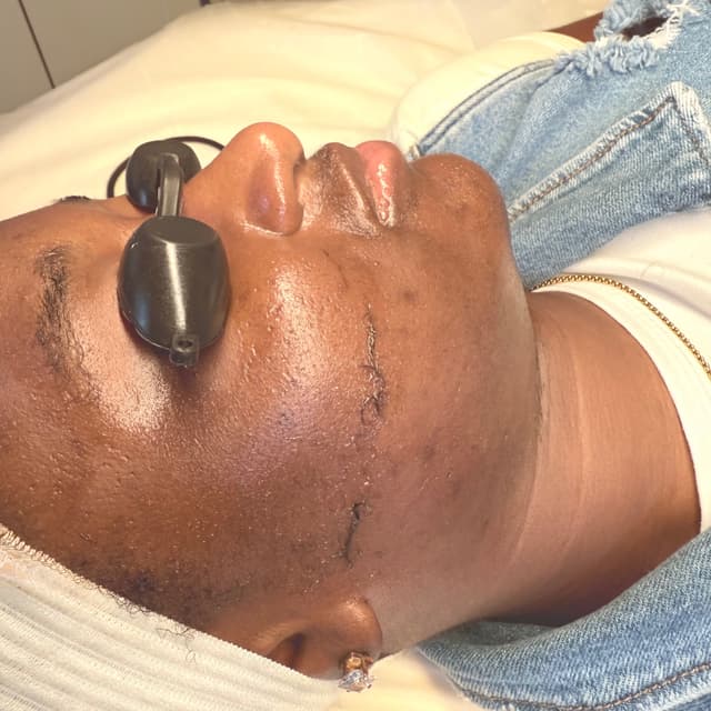 Advanced Facials Package -6 months at Refinery Aesthetics Loft in Oxon Hill, MD