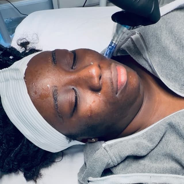 Microneedling- 6 months at Refinery Aesthetics Loft in Oxon Hill, MD